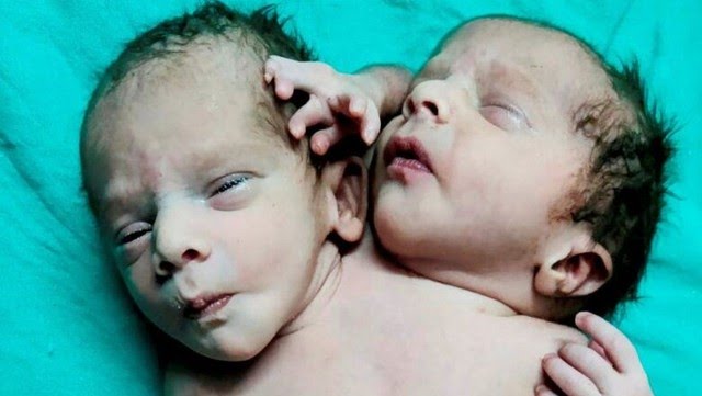 En la India nació un bebé con dos cabezas, tres manos y dos corazones